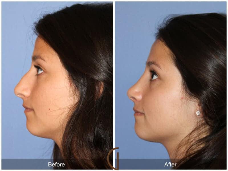 Rhinoplasty Before & After Photo