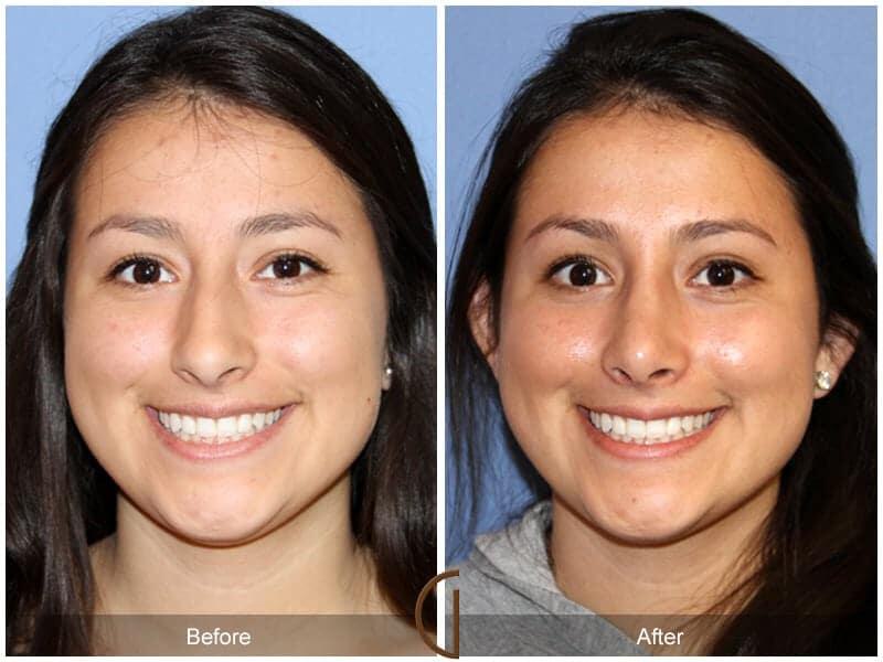 Rhinoplasty Before & After Photo