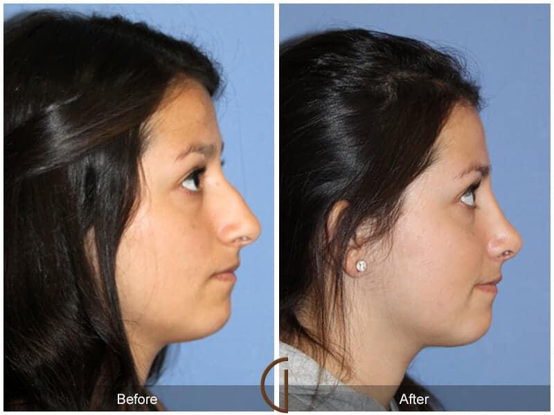 Rhinoplasty Before & After Photo