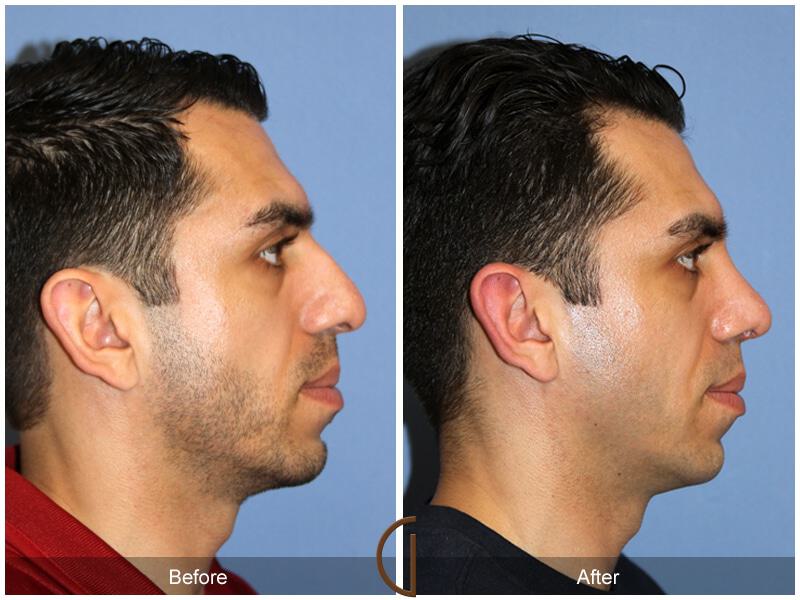 Rhinoplasty Before & After Photo