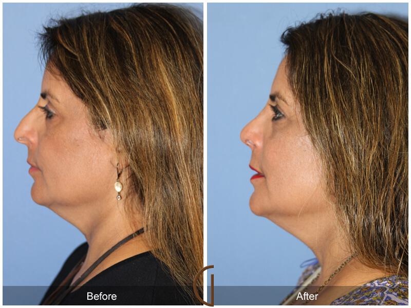 Rhinoplasty Before & After Photo