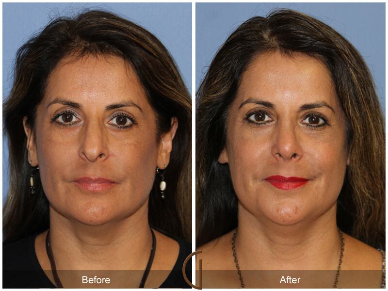 Rhinoplasty Before & After Photo