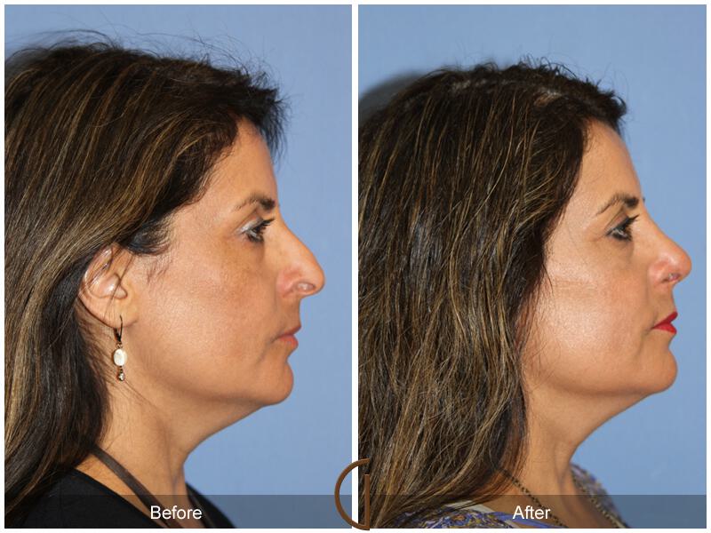 Rhinoplasty Before & After Photo