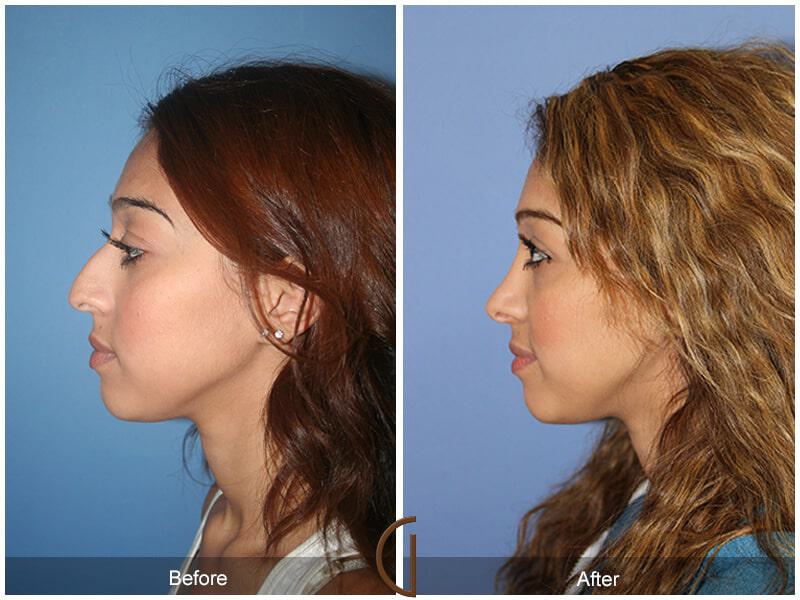 Rhinoplasty Before & After Photo