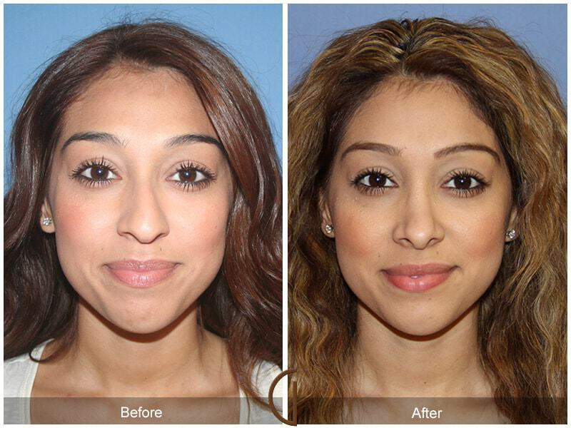 Rhinoplasty Before & After Photo