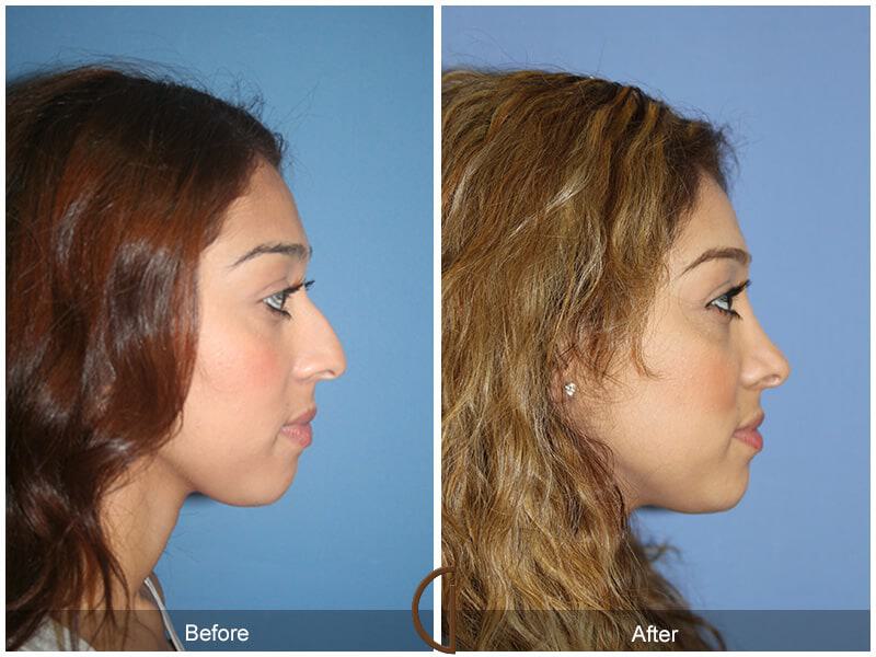 Rhinoplasty Before & After Photo