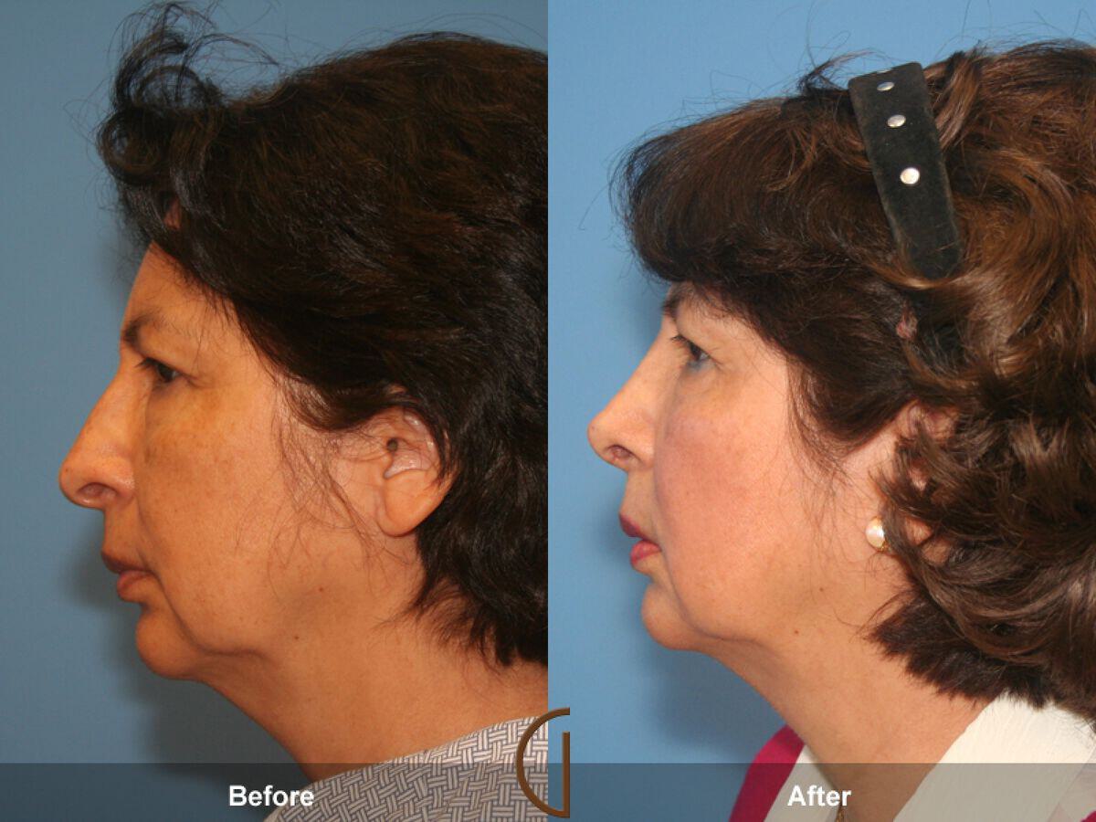 Rhinoplasty Before & After Photo