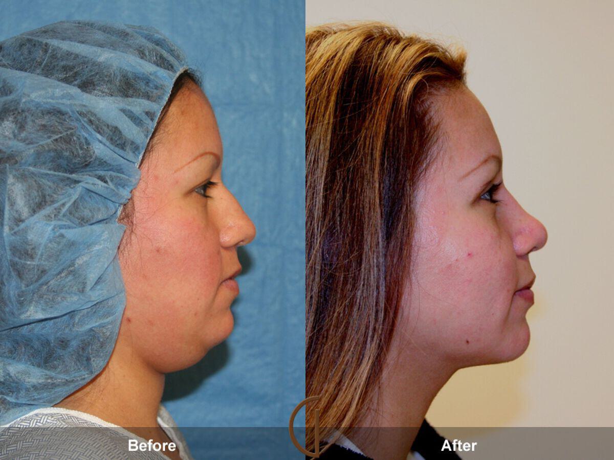 Rhinoplasty Before & After Photo