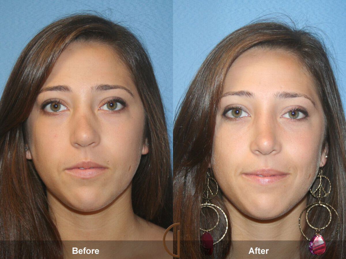 Rhinoplasty Before & After Photo