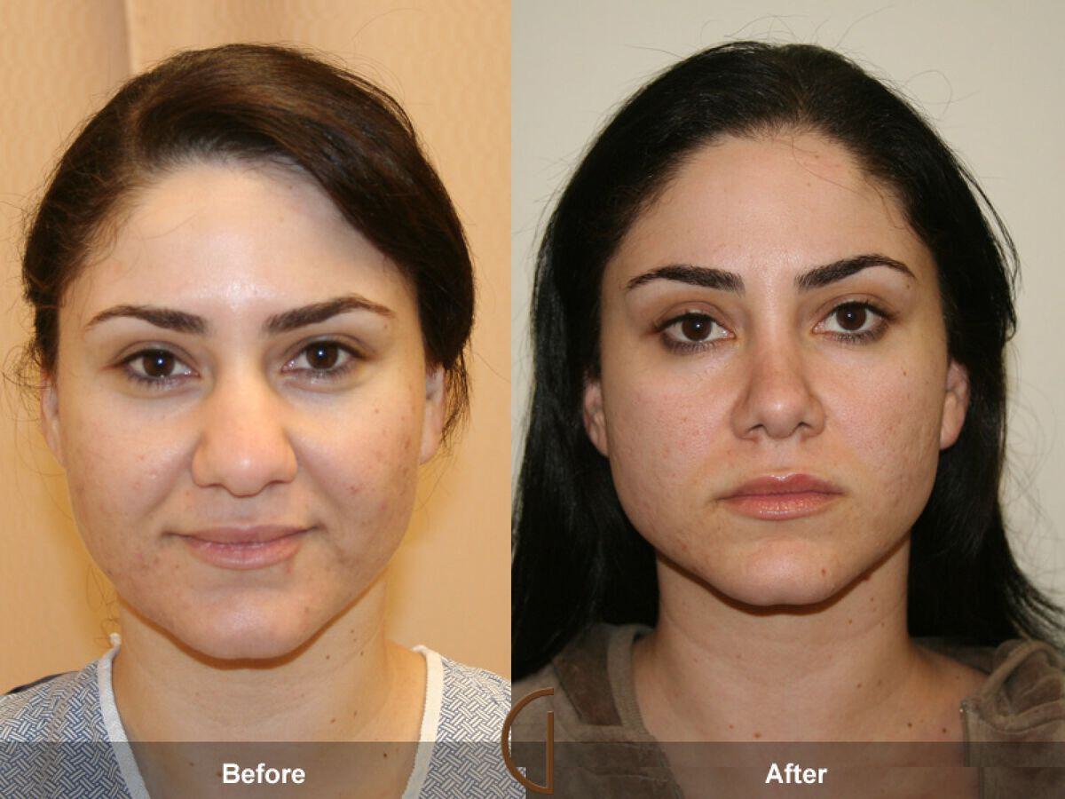 Rhinoplasty Before & After Photo