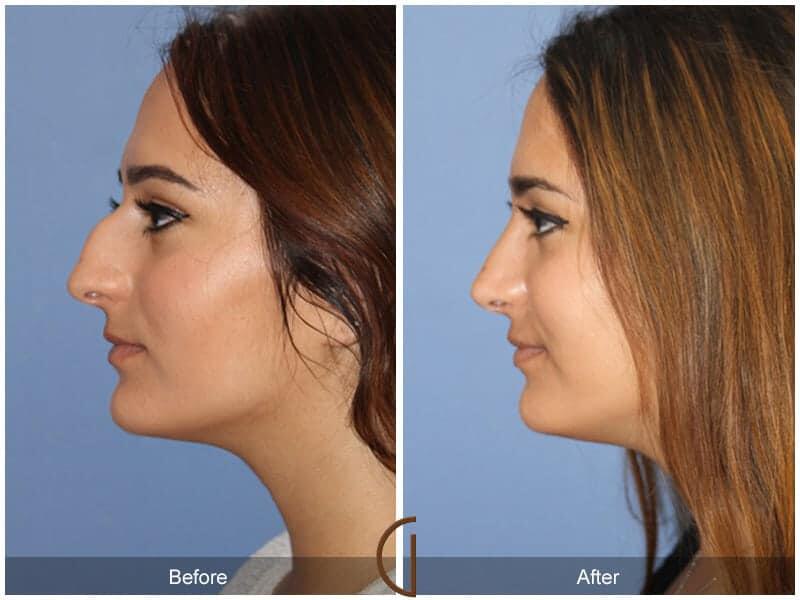 Rhinoplasty Before & After Photo