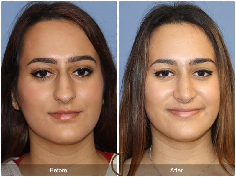 Rhinoplasty Before & After Photo