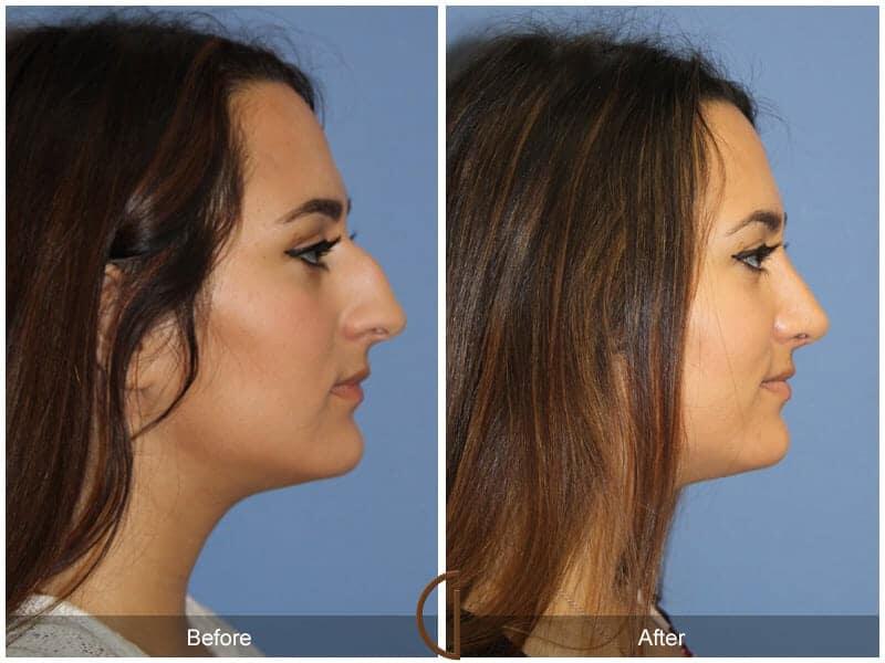 Rhinoplasty Before & After Photo