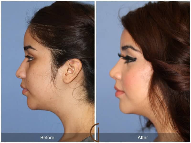 Rhinoplasty Before & After Photo