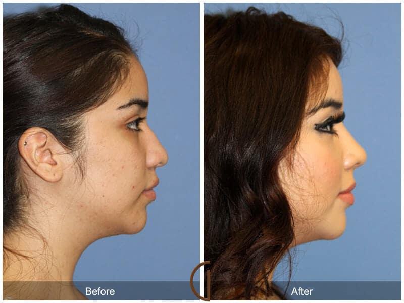 Rhinoplasty Before & After Photo