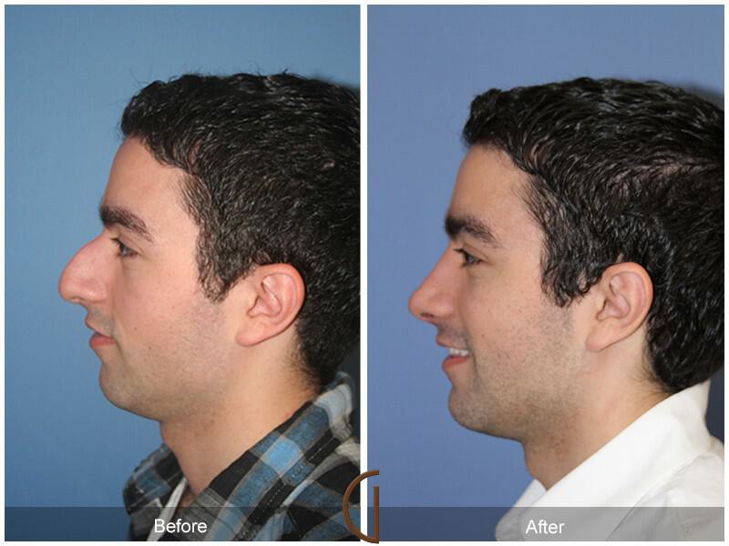 Rhinoplasty Before & After Photo