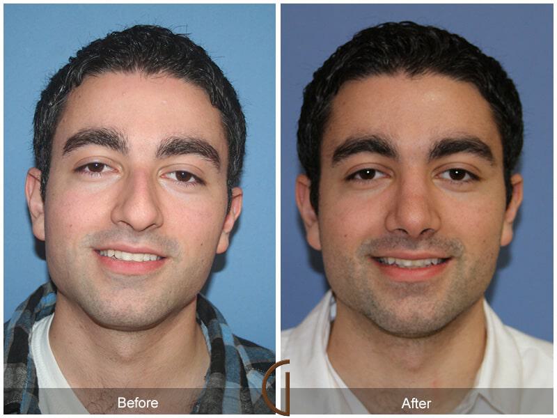 Rhinoplasty Before & After Photo