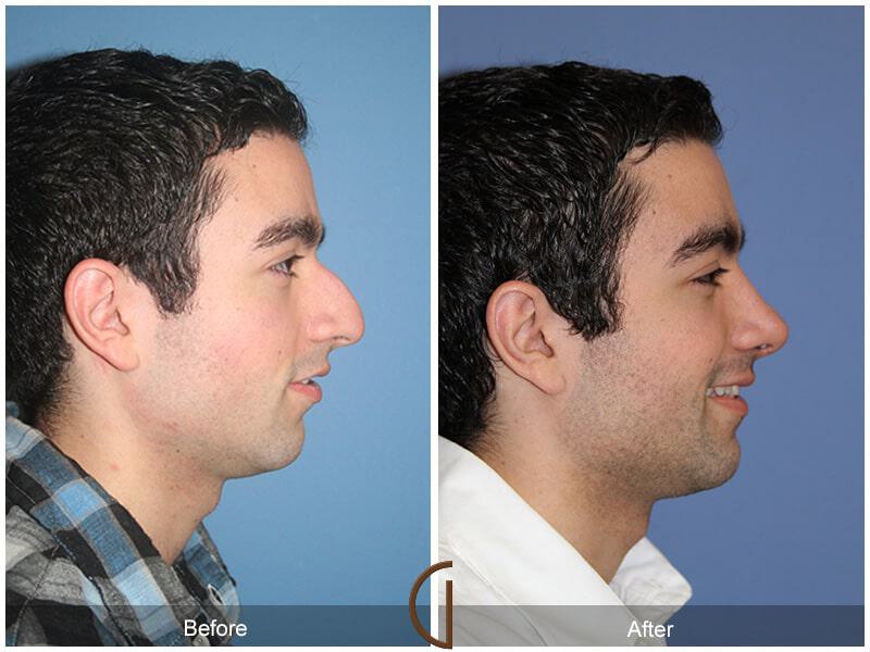 Rhinoplasty Before & After Photo