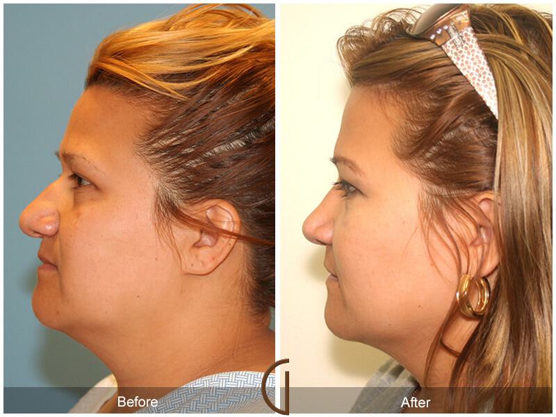 Rhinoplasty Before & After Photo