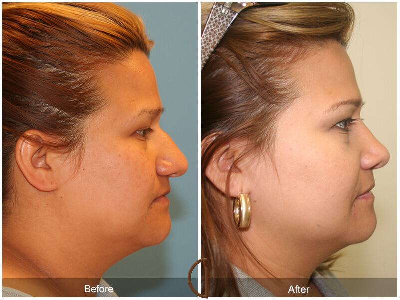 Rhinoplasty Before & After Photo