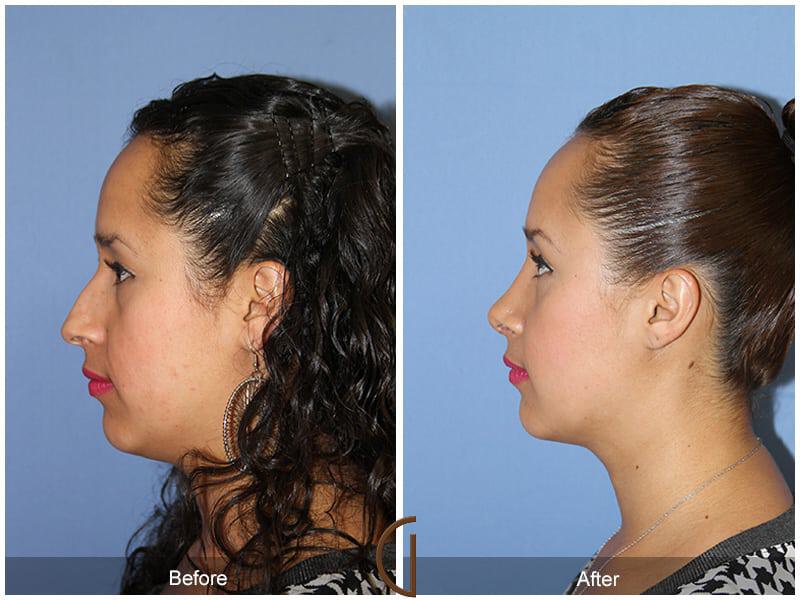 Rhinoplasty Before & After Photo