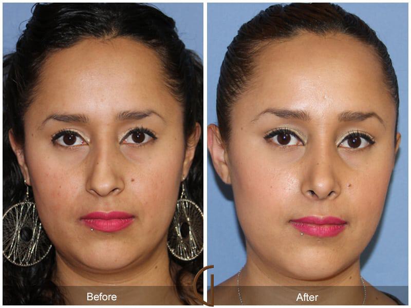 Rhinoplasty Before & After Photo