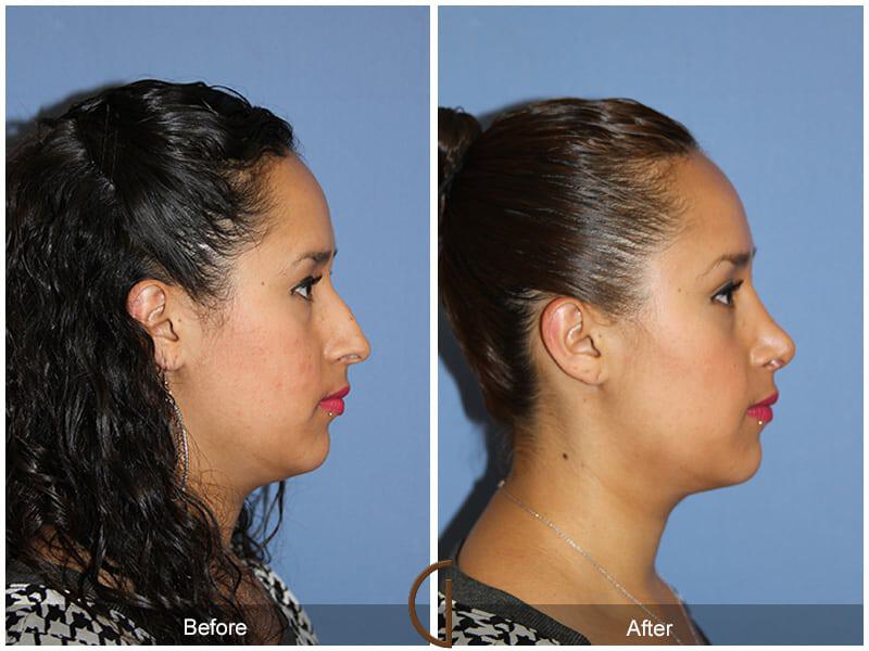 Rhinoplasty Before & After Photo