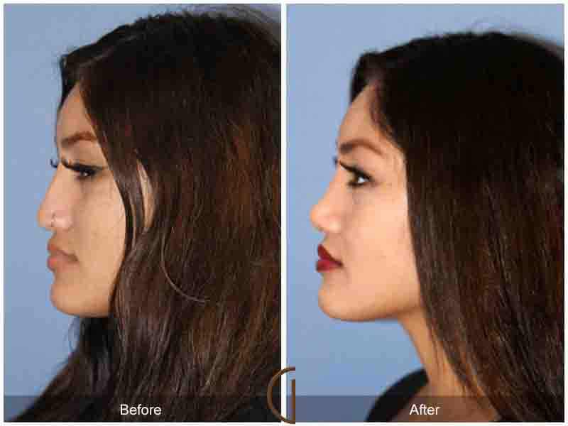 Rhinoplasty Before & After Photo