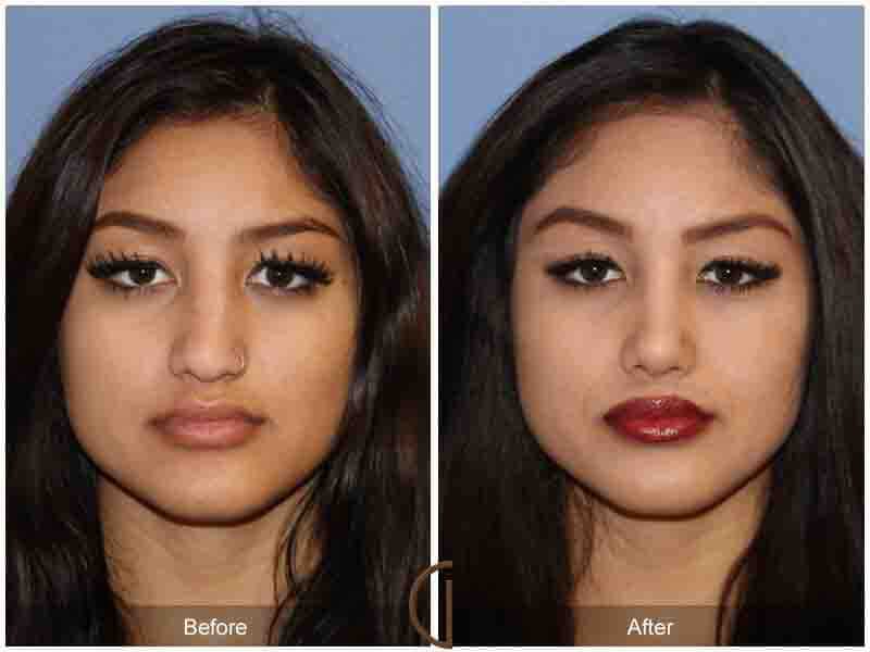 Rhinoplasty Before & After Photo