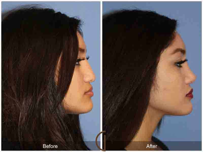 Rhinoplasty Before & After Photo