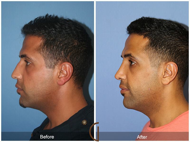 Rhinoplasty Before & After Photo