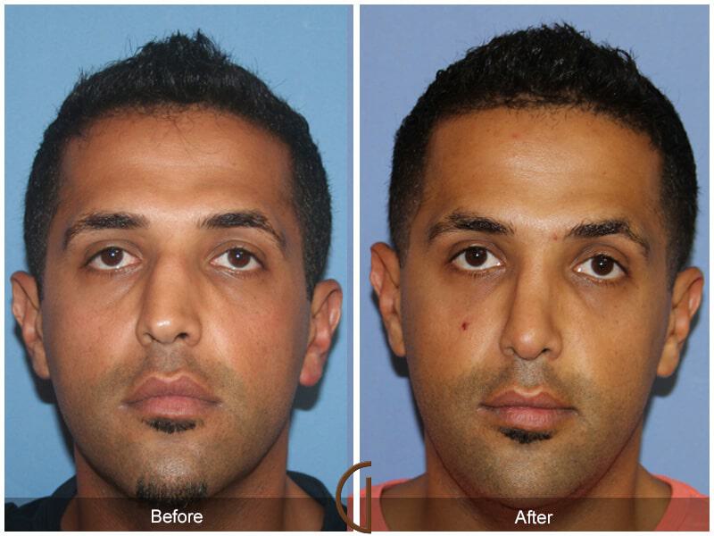 Rhinoplasty Before & After Photo