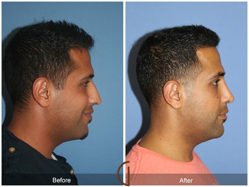 Rhinoplasty Before & After Photo