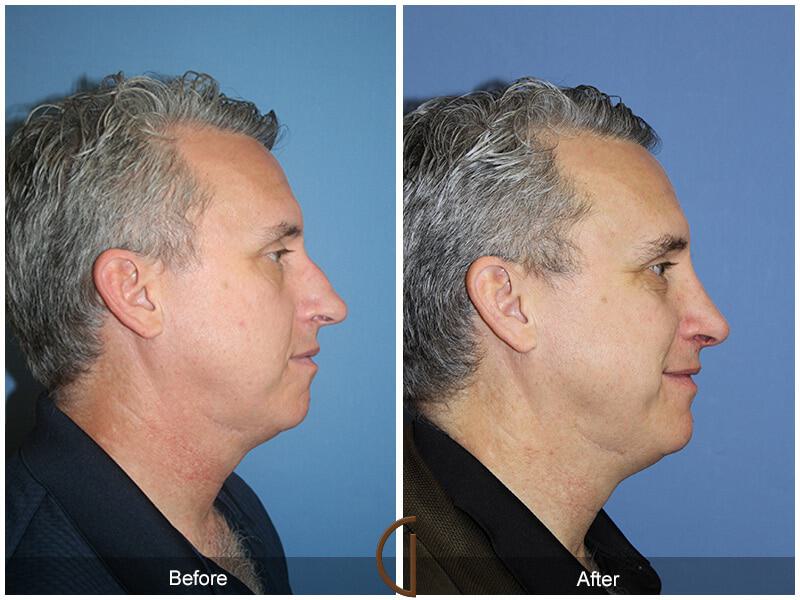 Rhinoplasty Before & After Photo