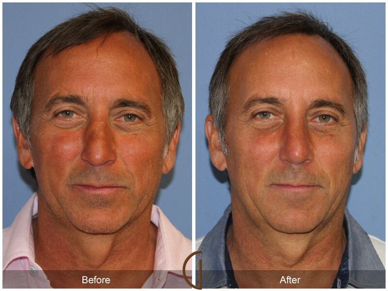 Rhinoplasty Before & After Photo