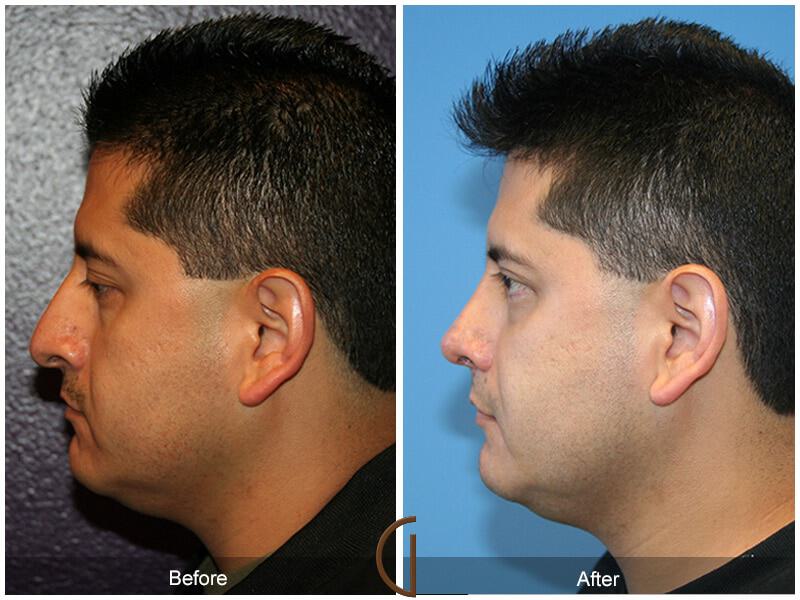 Rhinoplasty Before & After Photo