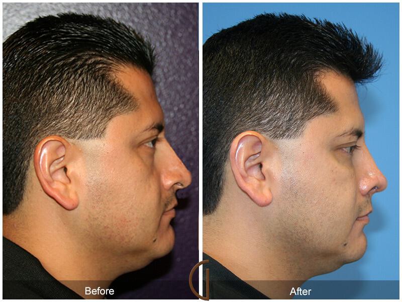 Rhinoplasty Before & After Photo