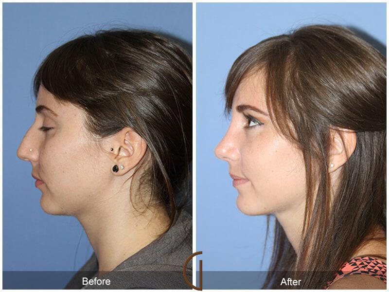 Rhinoplasty Before & After Photo