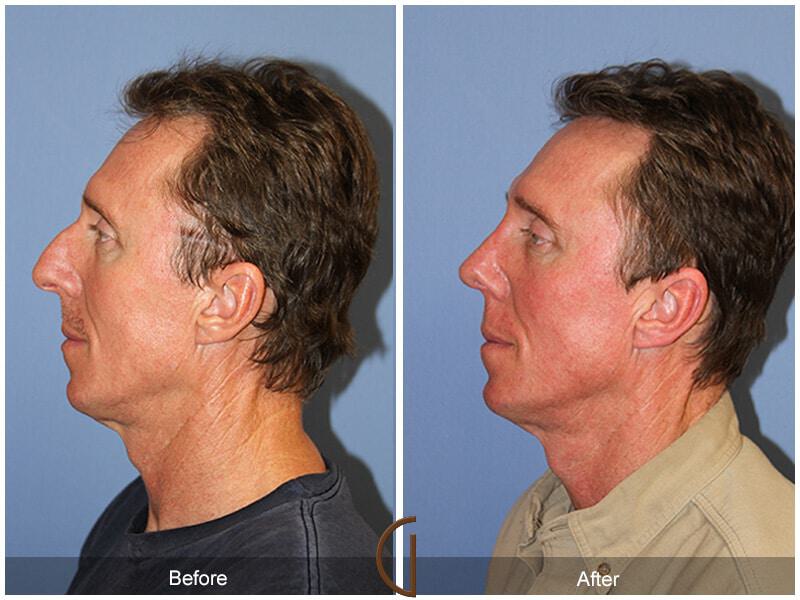 Rhinoplasty Before & After Photo