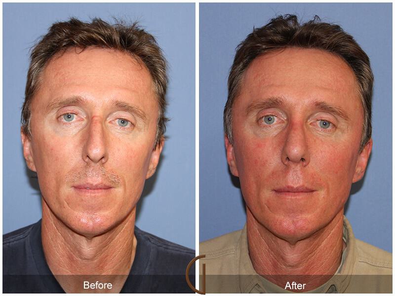 Rhinoplasty Before & After Photo