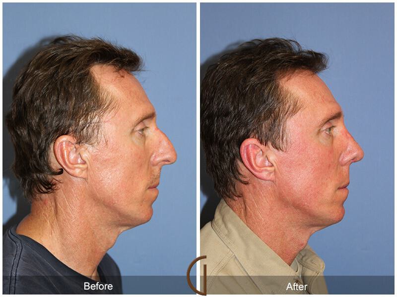 Rhinoplasty Before & After Photo