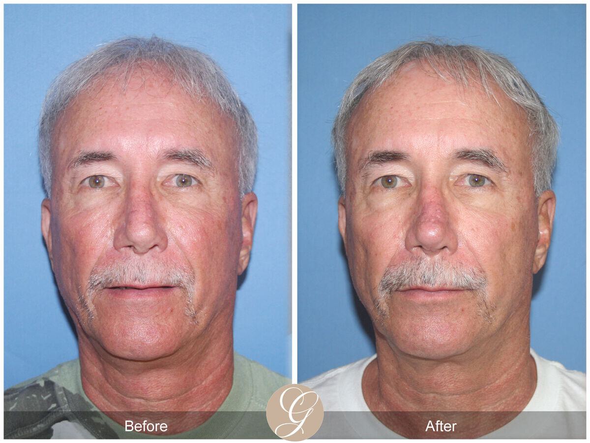 Rhinoplasty Before & After Photo