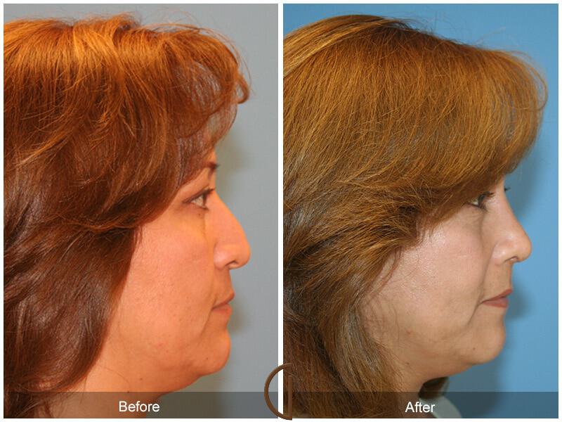 Rhinoplasty Before & After Photo