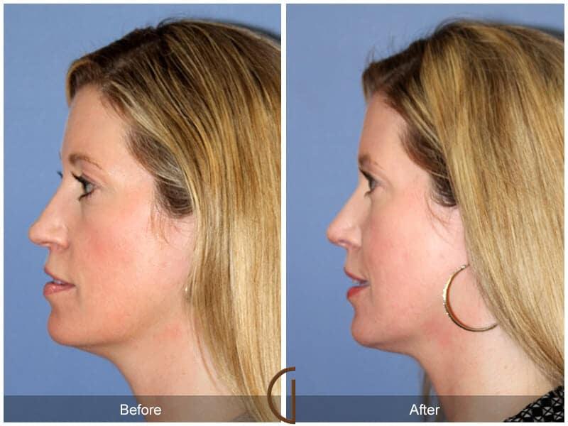 Tip Rhinoplasty Before & After Photo