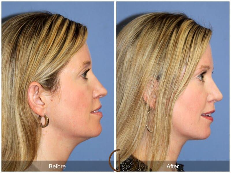 Tip Rhinoplasty Before & After Photo