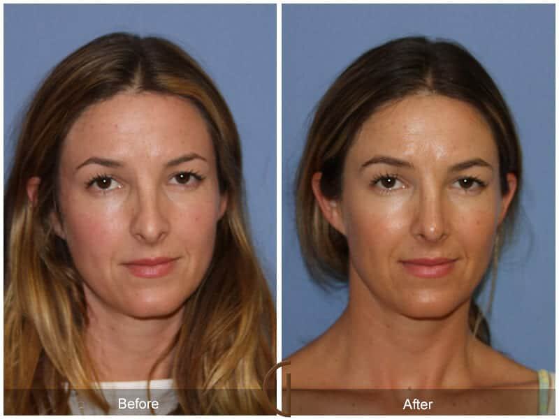 Tip Rhinoplasty Before & After Photo