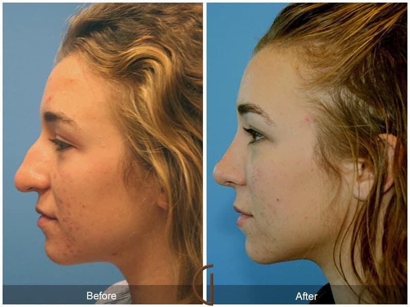 Tip Rhinoplasty Before & After Photo