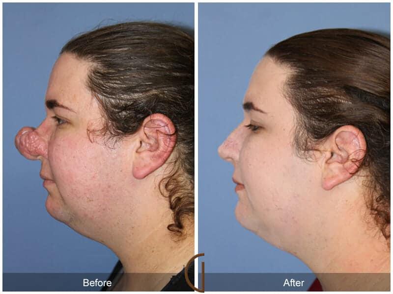 Tip Rhinoplasty Before & After Photo