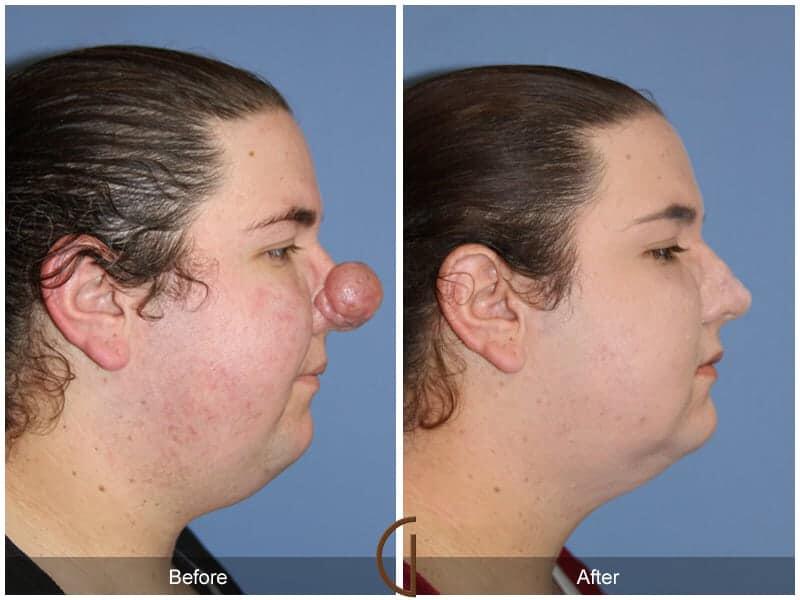 Tip Rhinoplasty Before & After Photo