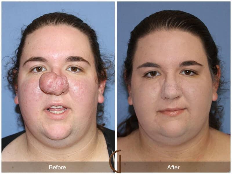 Tip Rhinoplasty Before & After Photo